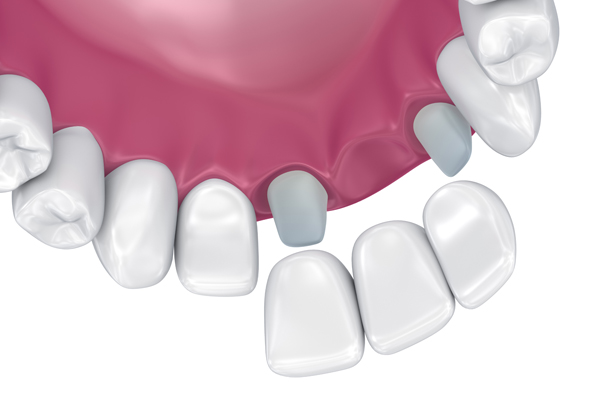 Signs You Might Need A Dental Bridge Instead Of A Denture