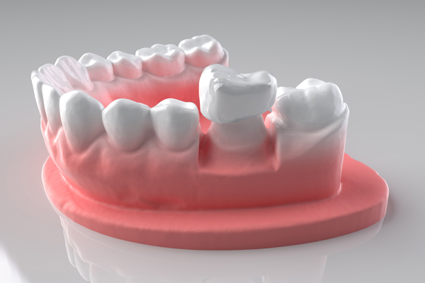 How Dental Crowns Can Give You A New Smile