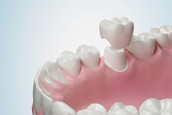 A Step By Step Guide To Getting A Dental Crown