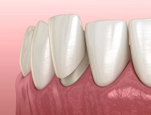 Surprising Benefits Of Getting Dental Veneers